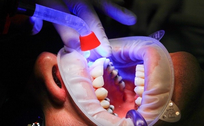 عوامل تاثیر گذار بر ماندگاری کامپوزیت دندان