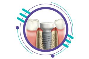 مراحل ایمپلنت دندان - کاشت و جایگذاری هیلینگ یا تاج موقت
